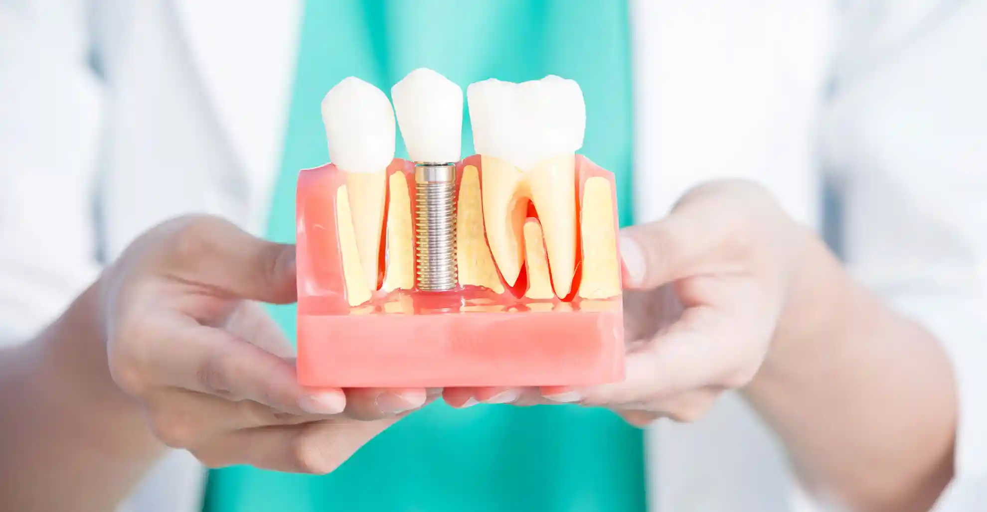 Why Dental Implant Surgery Is The Best Solution For Missing Teeth