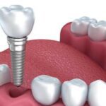 Elevate Your Space: Exploring Internal Window Shutters and Opening Roof Pergolas