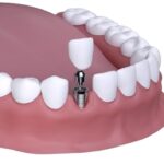 Nurturing Smiles: A Comprehensive Guide to Dental Care in Templestowe