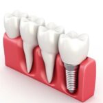 Nurturing Smiles: A Comprehensive Guide to Dental Care in Templestowe