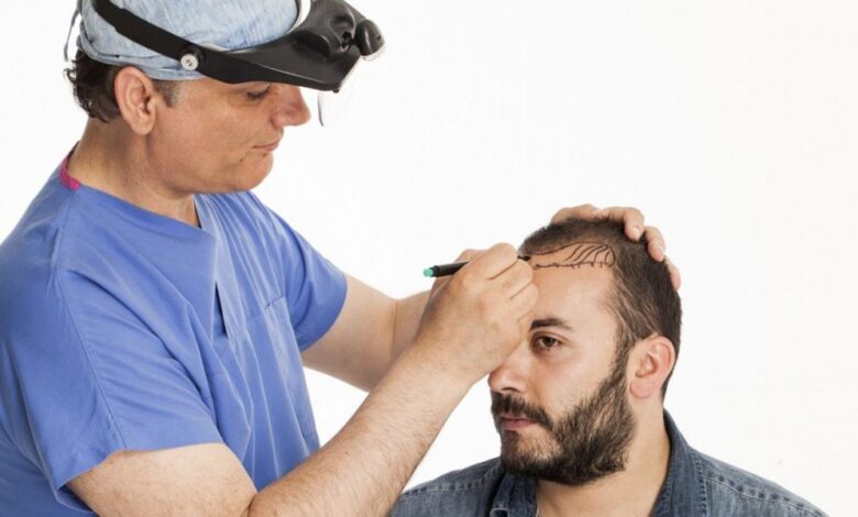 fue hair transplant