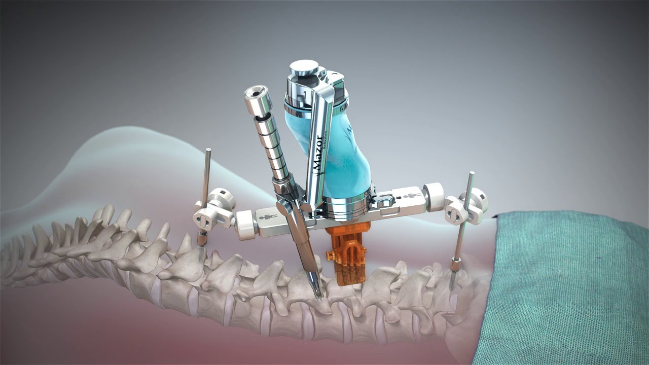 Navigating the World of Minimally Invasive Cervical Spine Surgery