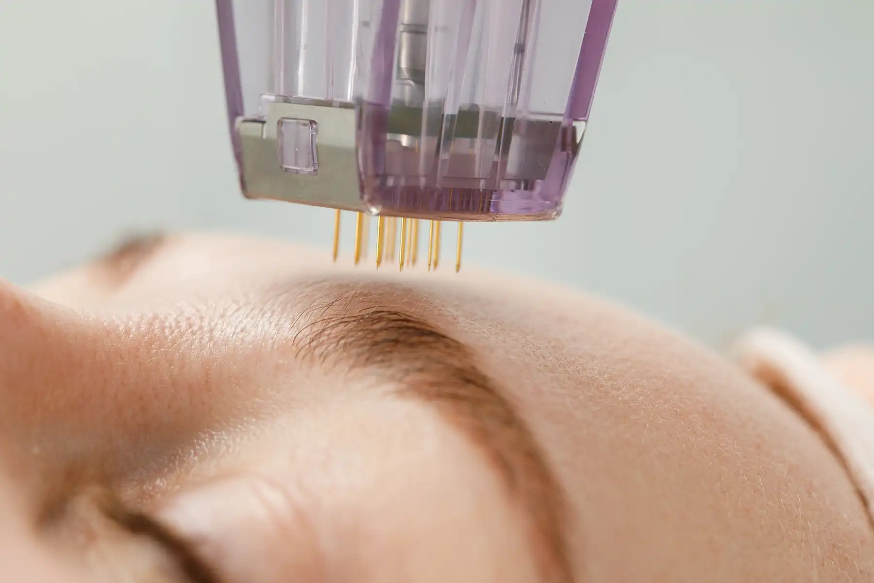 RF Microneedling: The Future of Skin Rejuvenation