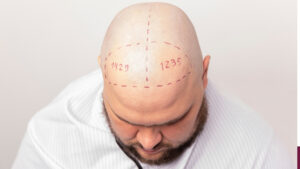 Hair Transplant Exosomes