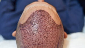 Transgender Hair Transplant