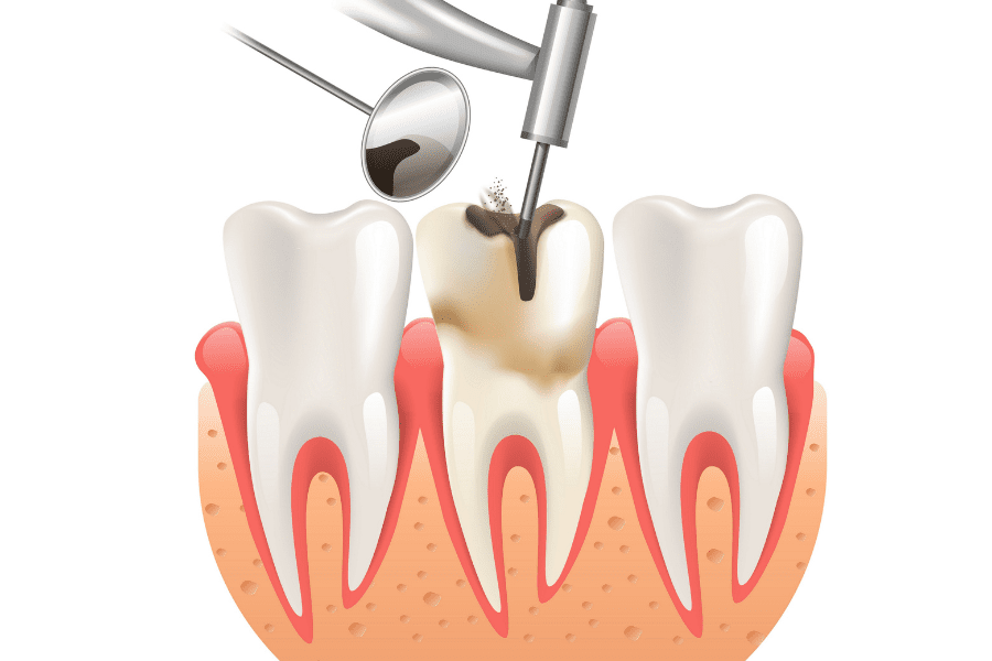 Is It Really Time for a Root Canal? Signs Canberra Dentists Want You to Notice