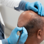 What Men Should Know About Hair Loss Treatment Options