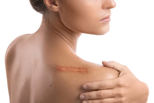 Keloids: Understanding, Managing, and Reducing Abnormal Scar Growth
