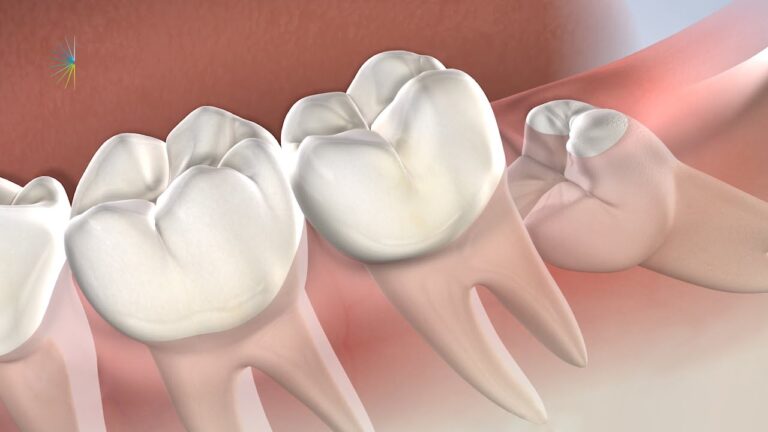 Wisdom Tooth Removal