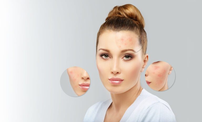 Acne-Prone-Skin